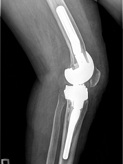 В ФГБУ "ФЦТОЭ" Минздрава России (г. Смоленск) впервые проведена операция ревизионного эндопротезирования коленного сустава с использованием индивидуального импланта